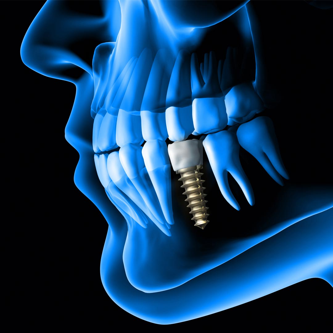 Dental Implants Cost in the UAE