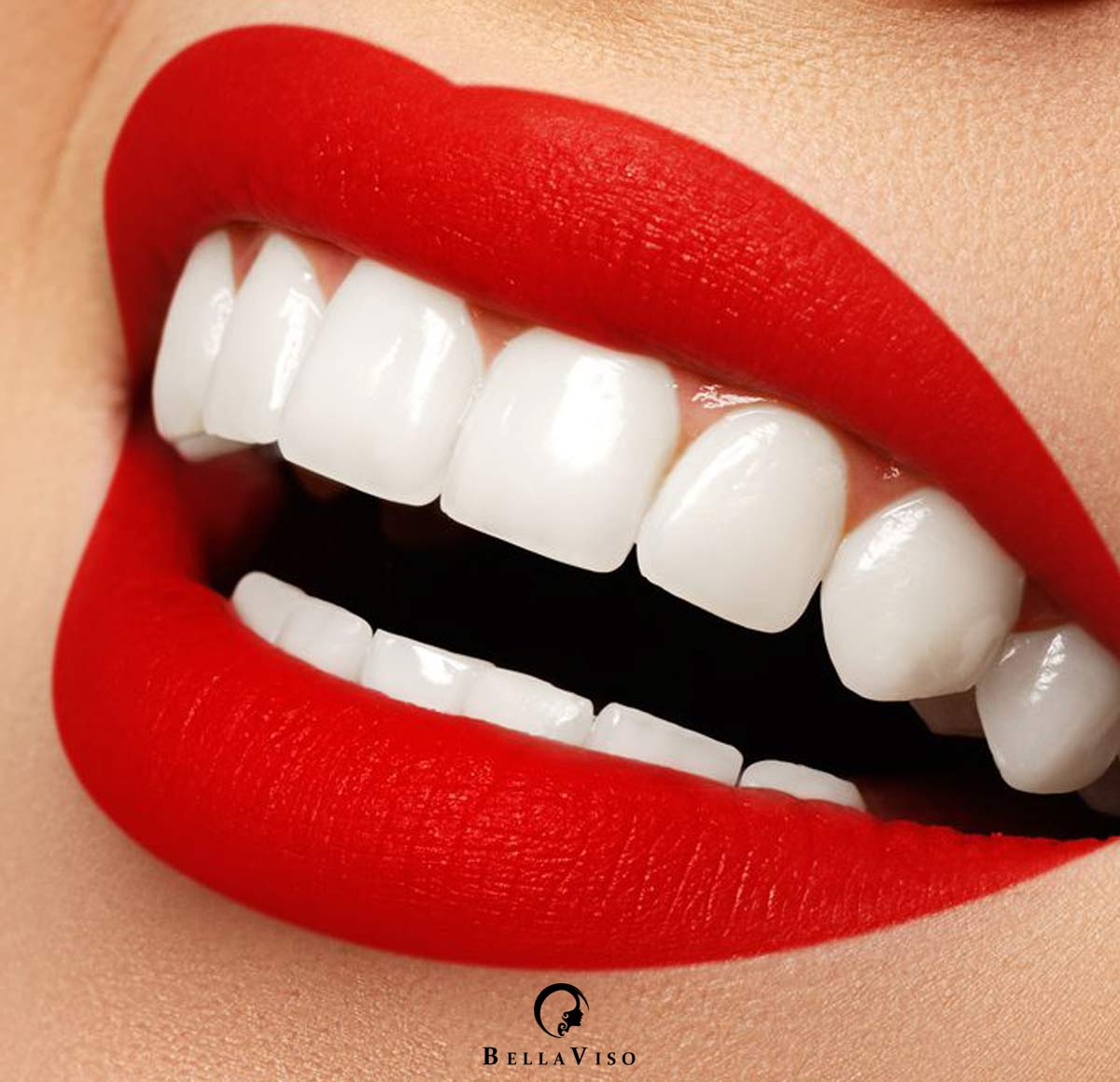 Affordable Veneers in Dubai